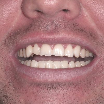 Composite Bonding - Smile 1 before